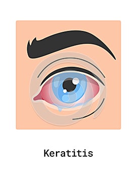 Keratitis Human Eye Disease