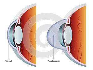 Keratoconus