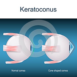Keratoconus. eyes disorder