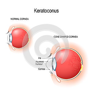 Keratoconus. Normal cornea and cone shaped cornea