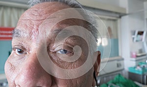 keratopathy bullous condition in eye of elderly patient