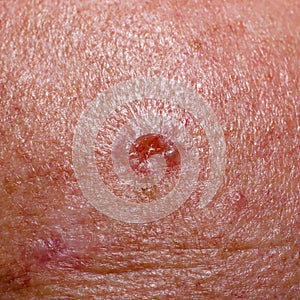 Keratosis or papilloma on the skin of an adult. Irritation or allergic reaction