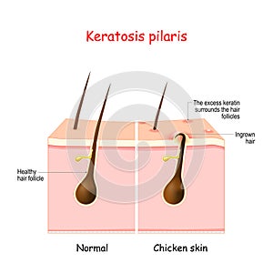 Keratosis pilaris. lichen pilaris and hair follicle