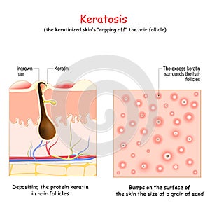 Keratosis. Skin disease