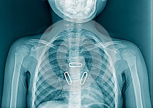 Kid chest x-ray image in blue tone