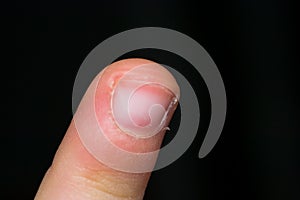 Kid finger peak on black background with exfoliated skin around the nail