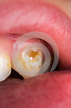 Kid patient open mouth showing cavities teeth decay. Close up of unhealthy baby teeth. macro of caries teeth decay