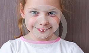 Kid with projecting upper front teeth photo