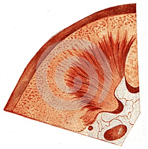Kidney, acute parenchymatous nephritis, vintage engraving photo