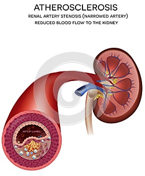 Kidney artery disease