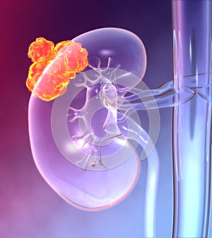 Kidney cancer, colorful medically 3D illustration