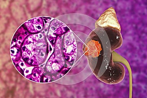 Kidney cancer, illustration and light micrograph