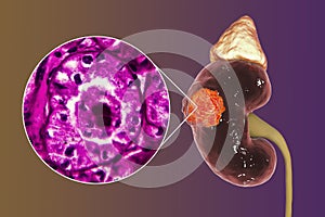 Kidney cancer, illustration and light micrograph