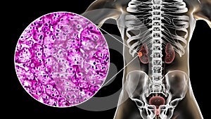 Kidney cancer, illustration and light micrograph