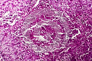 Kidney cancer, light micrograph