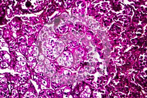 Kidney cancer, light micrograph