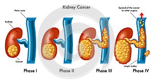 Kidney cancer