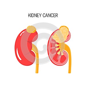 Kidney cancer vector concept