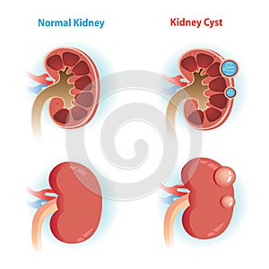 Kidney Cyst photo