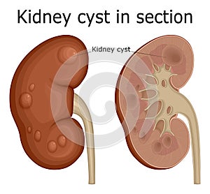 Kidney cyst in section