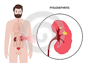 Kidney disease concept