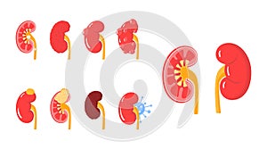Kidney diseases concept in flat style, vector