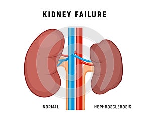 Kidney failure chronic disease urinary renal cancer. Kidney failure nephritis nephrosclerosis.