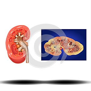 Kidney - internal organ, Kidney stones. Renal calculi, nephrolithiasis or urolithiasis, vector illustration on white background