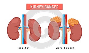 Kidney polycystic disease kidney cancer urology pyelonephritis failure tumor illustration photo