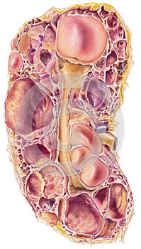 Kidney - Polycystic Kidney Disease photo