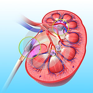 Kidney stone