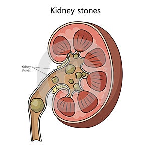 Kidney stone disease medical science