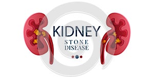 Kidney stone disease paper cut 3D poster