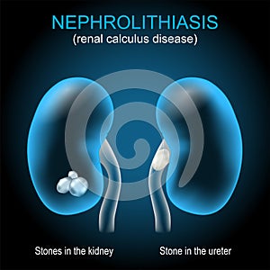Kidney stone disease. Renal calculus. Nephrolithiasis or urolithiasis