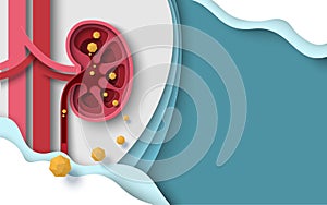 Kidney stone human renal disease vector background