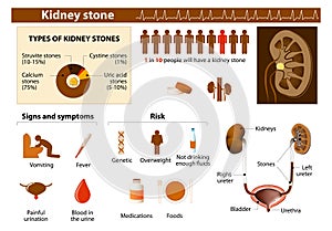 Kidney stone photo