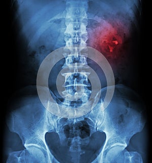 Kidney stone ( renal stone , renal calculi ) ( film x-ray KUB ( Kidney - Ureter - Bladder ) show left renal stone )