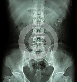 Kidney stone ( renal stone , renal calculi ) ( film x-ray KUB ( Kidney - Ureter - Bladder ) show left renal stone )