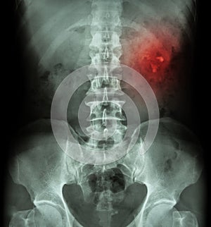 Kidney stone ( renal stone , renal calculi ) ( film x-ray KUB ( Kidney - Ureter - Bladder ) show left renal stone )