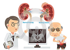 Kidney Stones