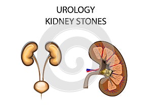 Kidney stones
