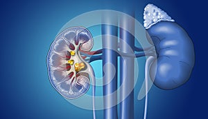 Kidney stones in kidney and ureter, medically illustration