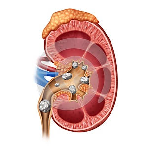 Kidney Stones