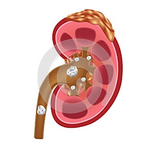 Kidney stones medical concept vector . anatomy