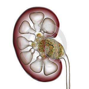 Kidney stones, nephrolithiasis photo