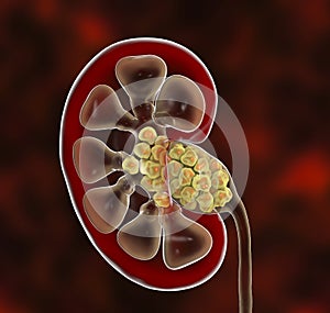 Kidney stones, nephrolithiasis photo