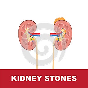 Kidney stones vector illustration