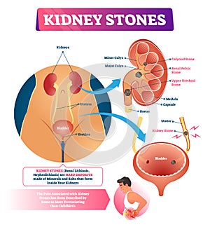 Kidney stones vector illustration. Labeled internal hard deposits disease. photo