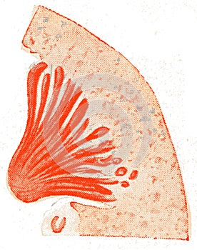 Kidney, subacute parenchymatous nephritis, vintage engraving