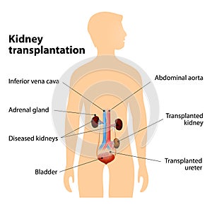 Kidney Transplantation photo